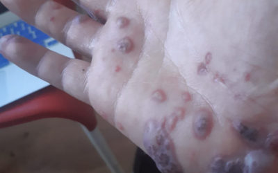 Triple or Quadruple COVID-Vax Recipients Now Developing SORES — **NOT** Monkeypox