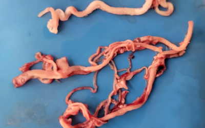 Amyloid Clots Found in EVERY SINGLE PERSON: Brand New Study